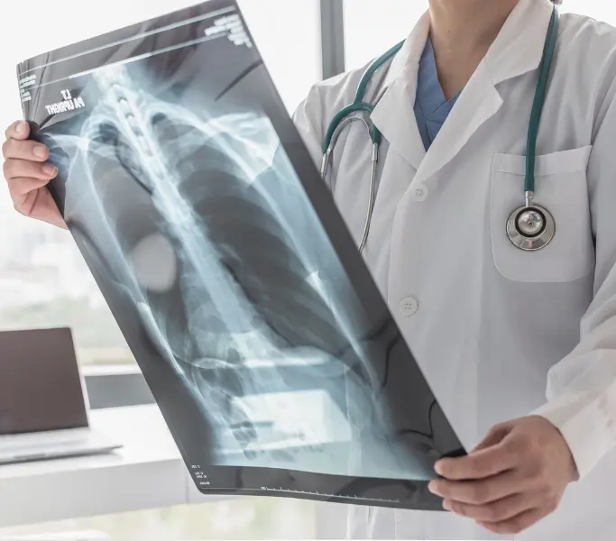 People With History Of Lung Cancer