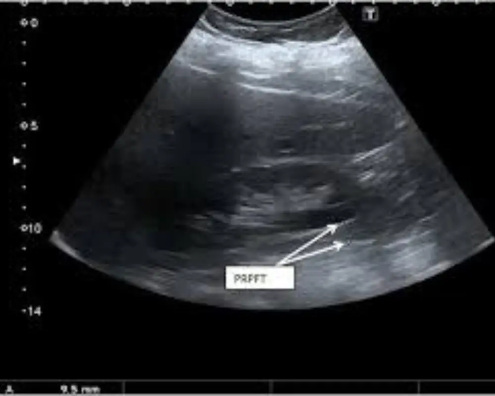 Abdominal Ultrasound