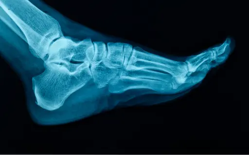 Bone X-Ray