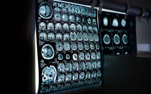 Brain Neurological Conditions