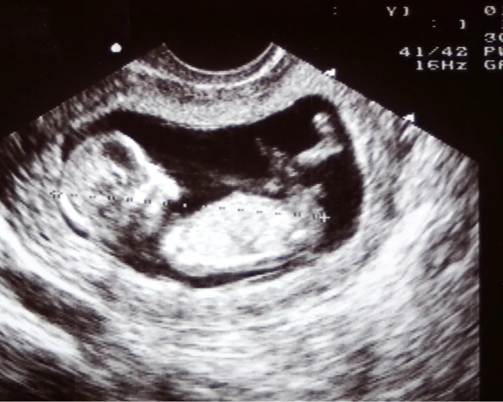 Pregnancy Ultrasound