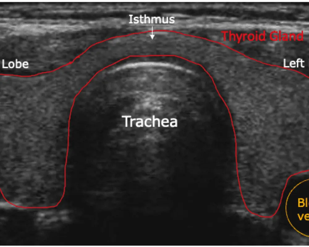 Thyroid Ultrasound