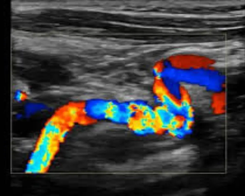 Vascular Ultrasound