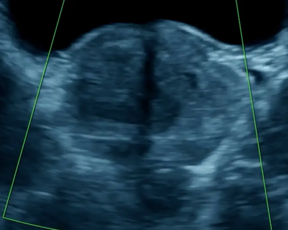 Pelvic Ultrasound