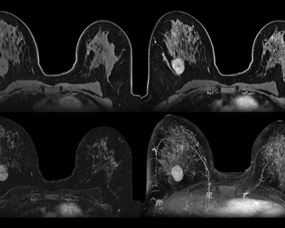 Breast Cancer Detection