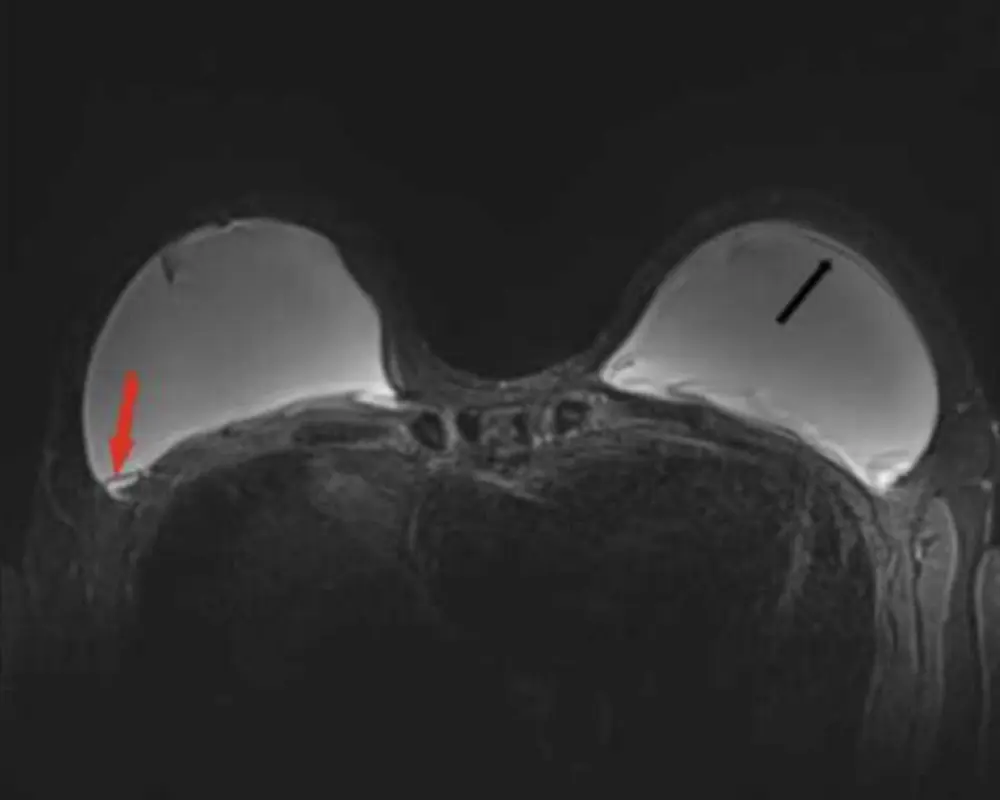 Breast Implant Evaluation