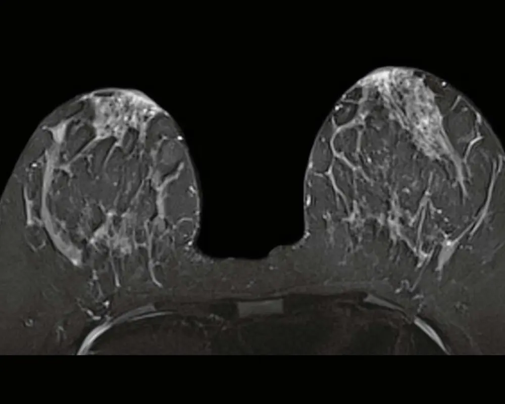 Breast MRI with Contrast