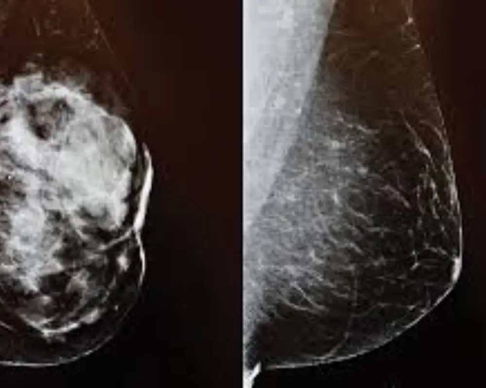 Dense Breast Tissue