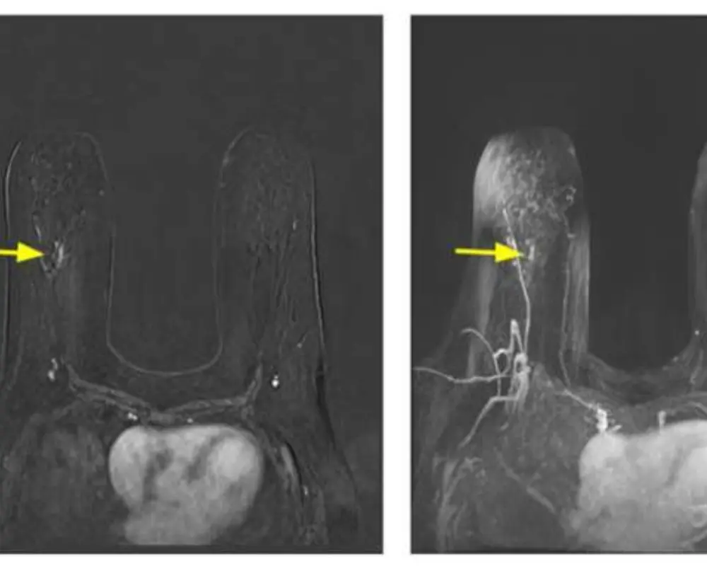 High Risk Screening MRI