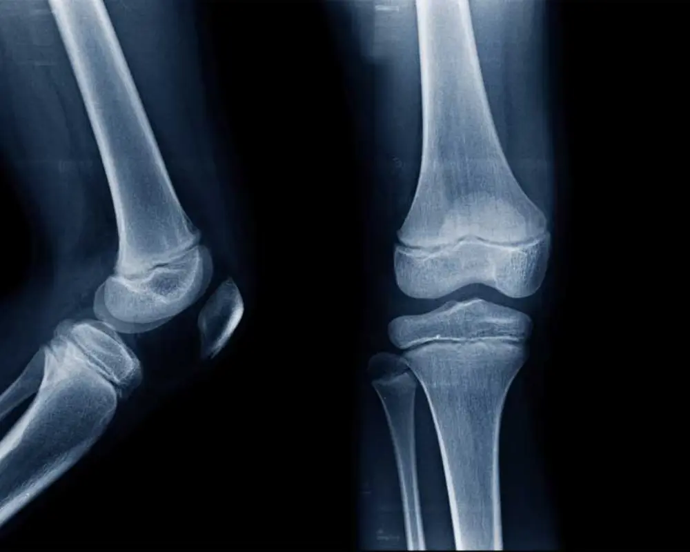 Joint and Cartilage Issues