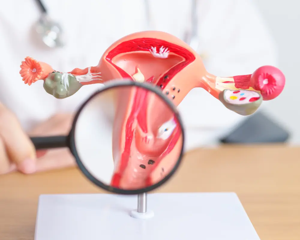 Ovarian Cysts or Masses