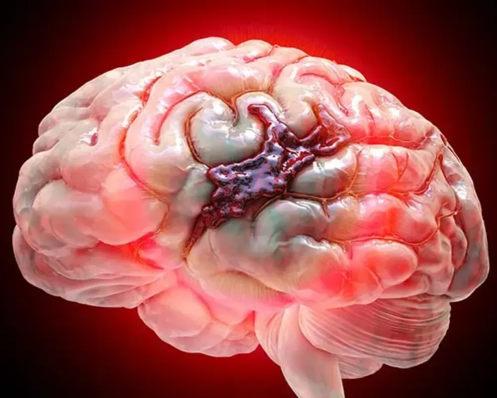 Stroke and Brain Bleeding