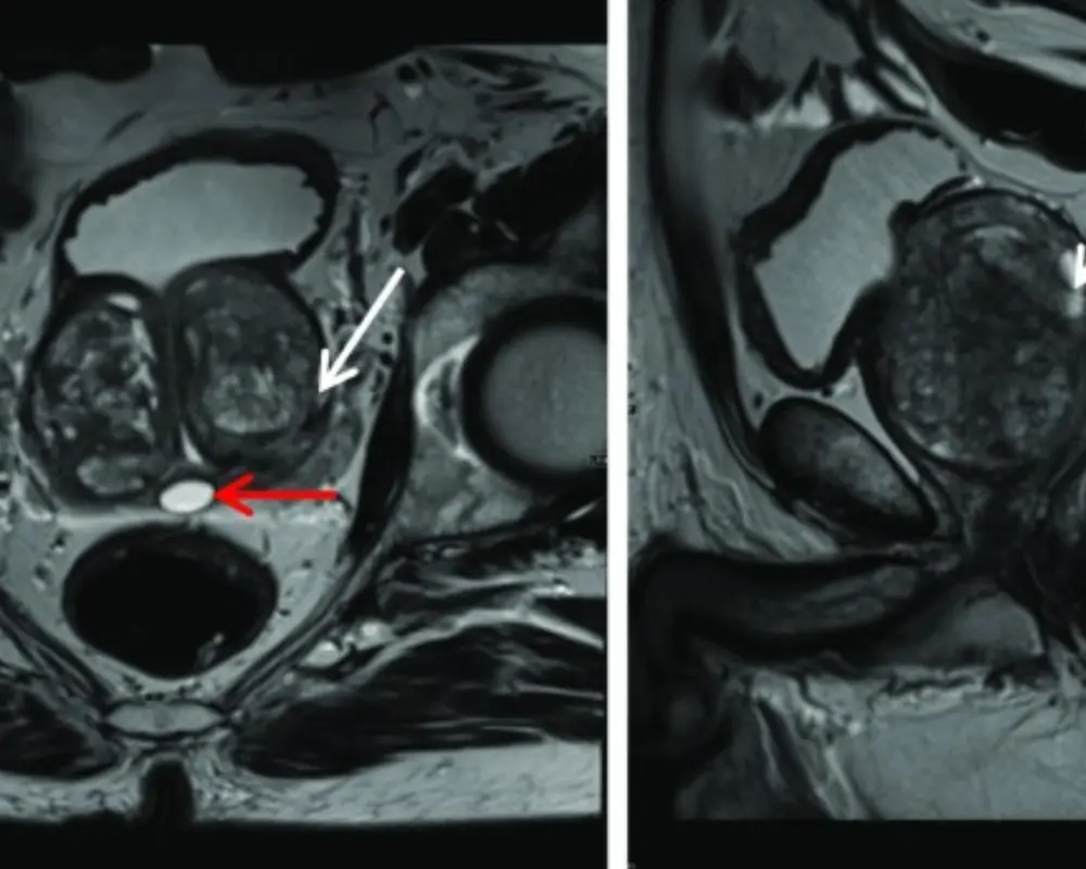 Suspicious Prostate Areas