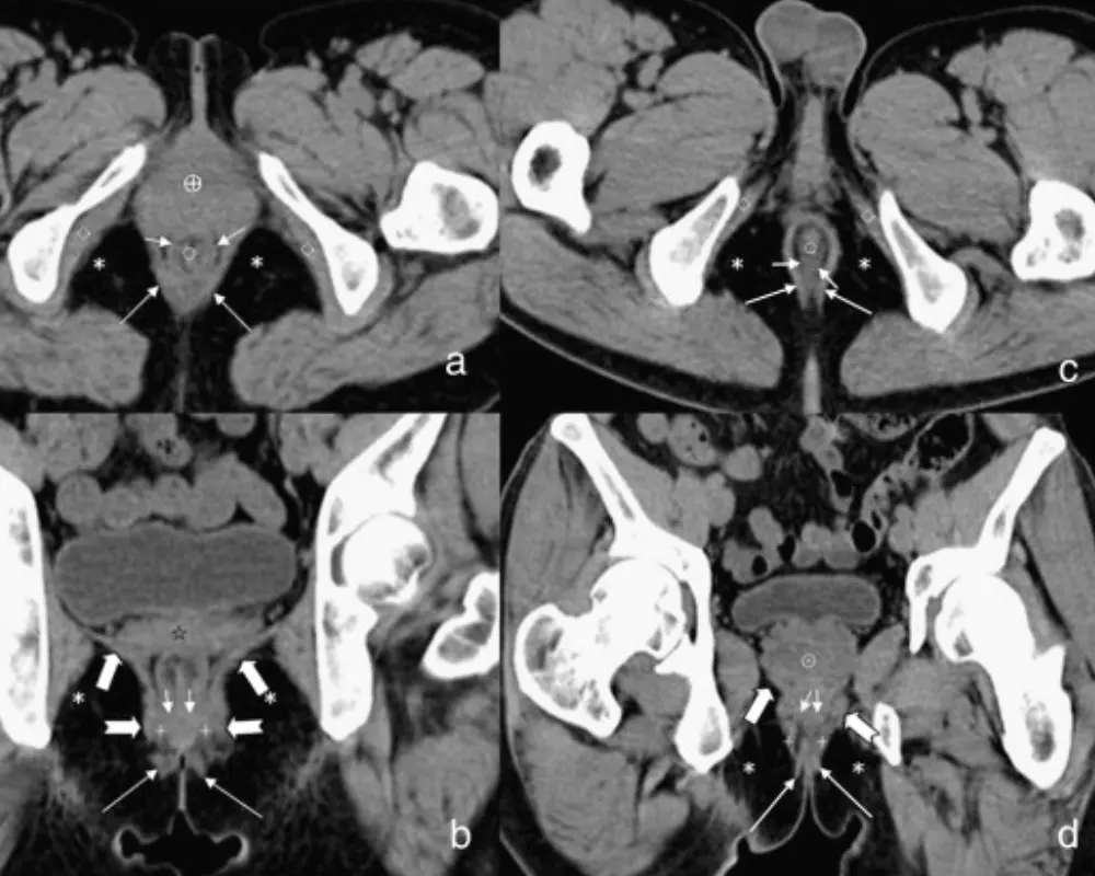 Abscesses or Fistulas