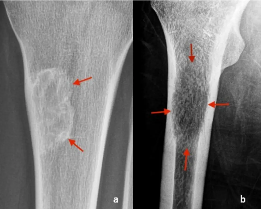 Bone Lesions