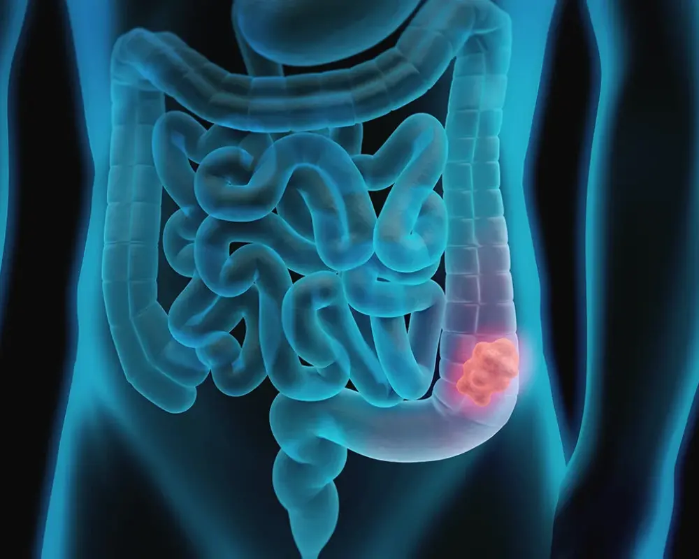 Bowel Narrowing