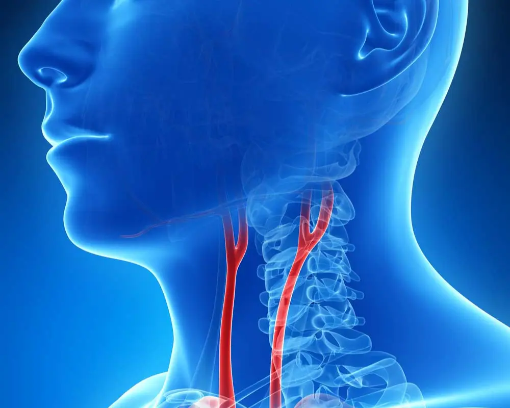 Carotid Artery Stenosis
