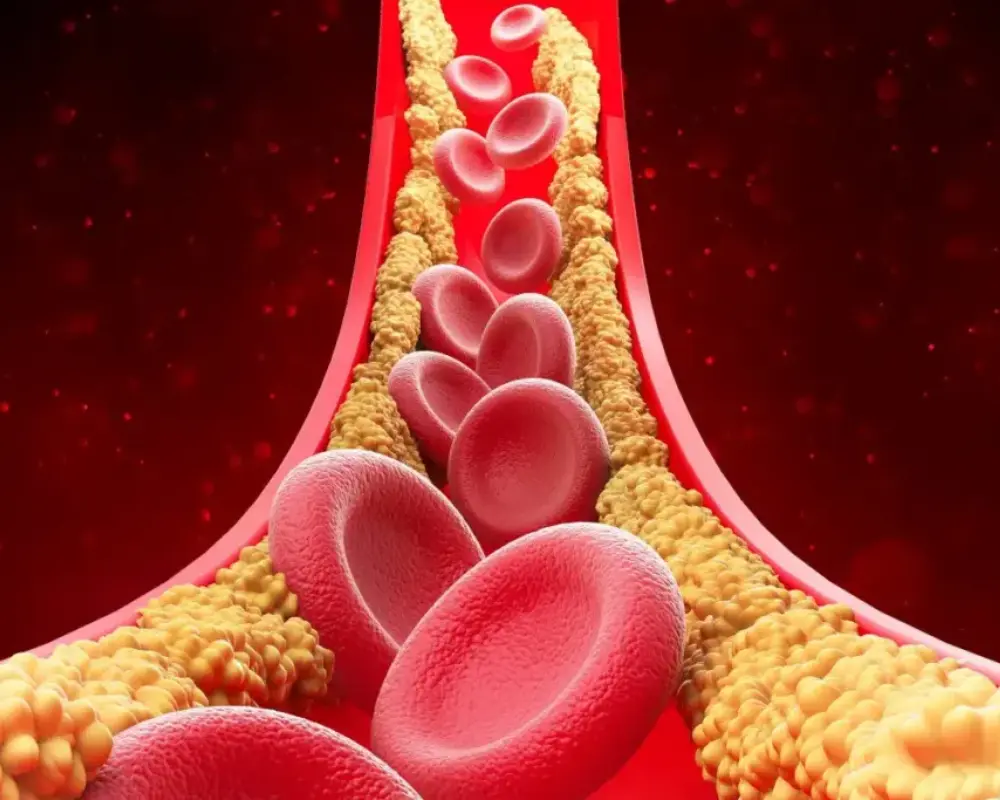 Coronary Calcium Buildup