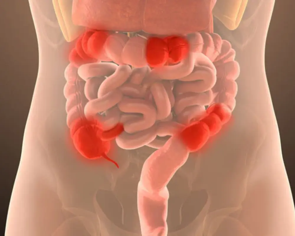 Crohn’s Disease