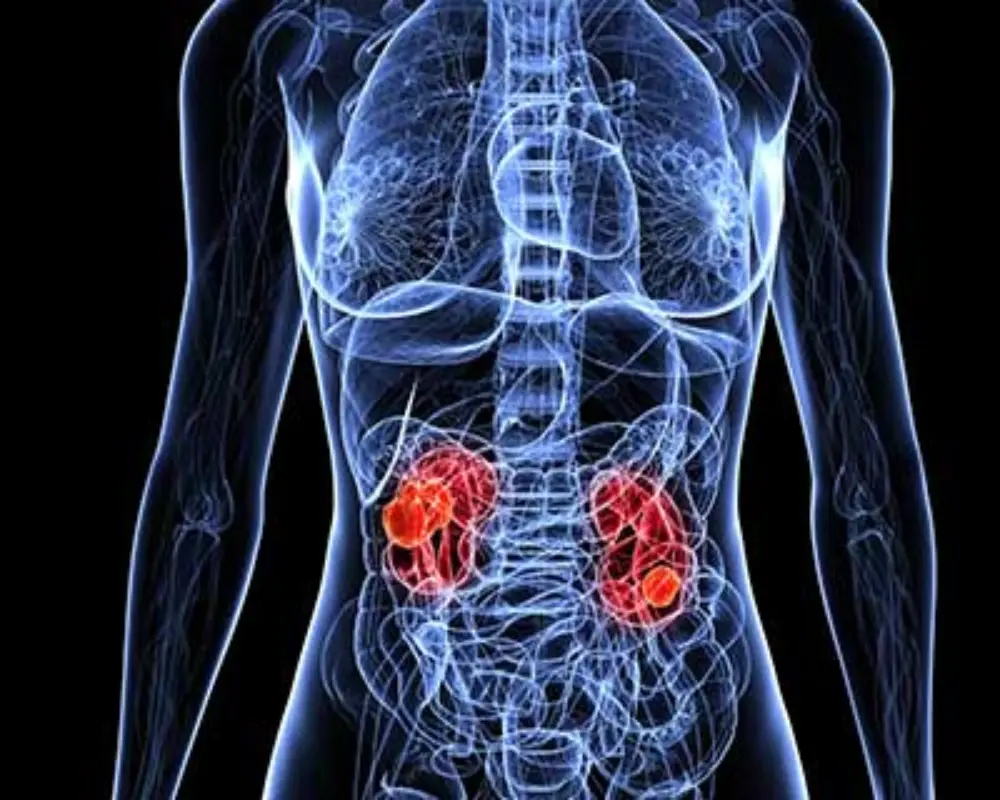Kidney Masses