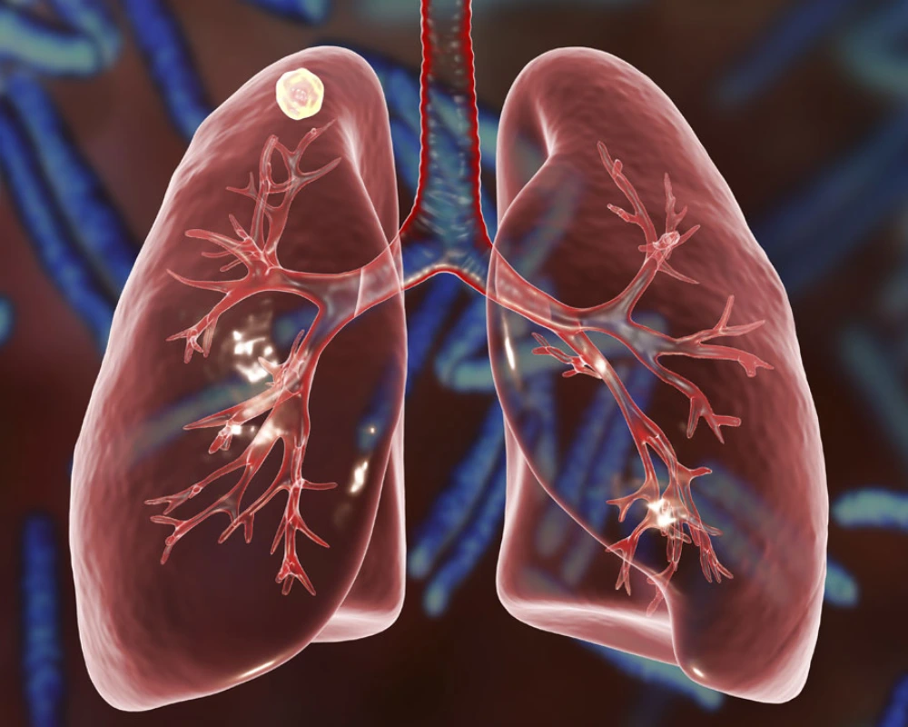 Lung Nodules