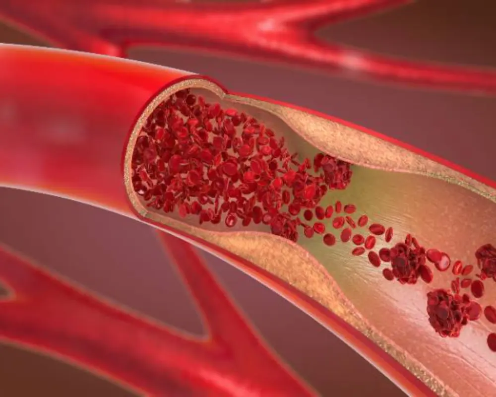 Narrowed Heart Arteries