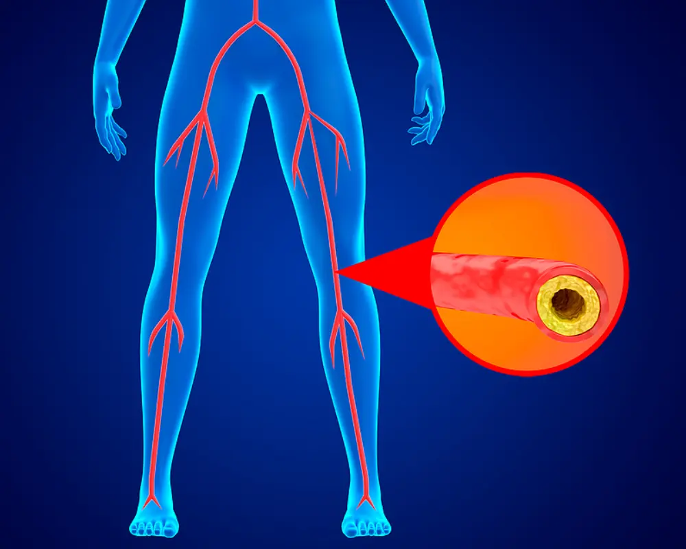 Peripheral Artery Disease