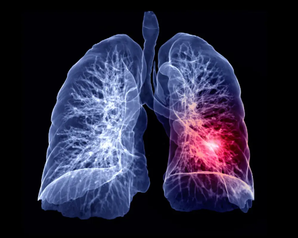 Pulmonary Embolism