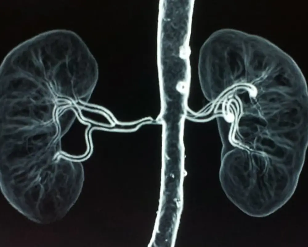Renal Artery Stenosis
