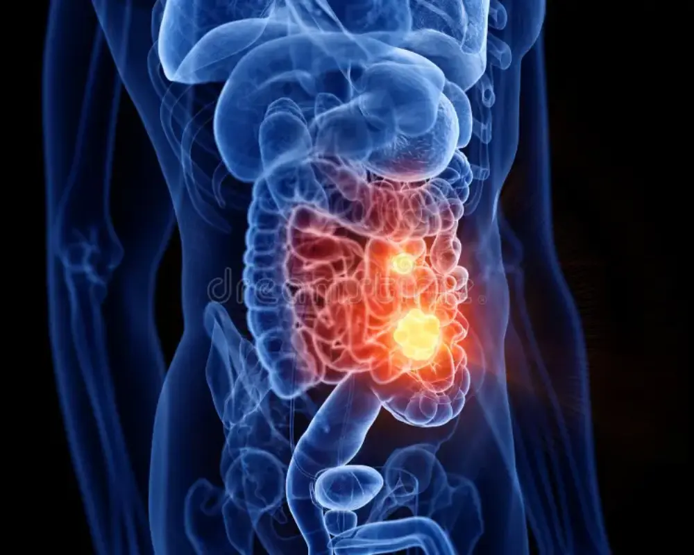 Small Bowel Tumors